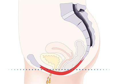 Pelvic-Floor Muscle Repair 5 Pelvic floor muscles Teddington