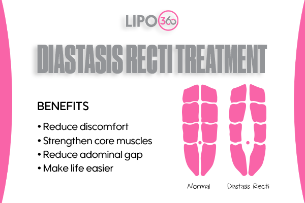 Revolutionising Muscle Repair: The Power of LIPO360 Body Sculpt Post-Injury 5 diastasis recti treatment Teddington