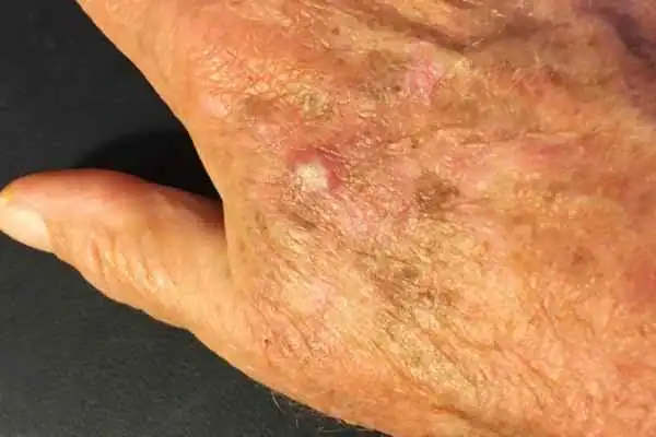 Cryopen For Actinic Keratoses 1 Image of Actinic keratoses Teddington on a person hand