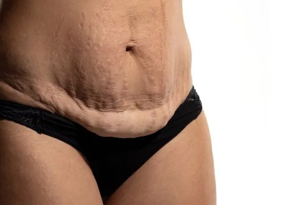 The science behind skin tightening Teddington picture of a woman's sagging skin on the stomach
